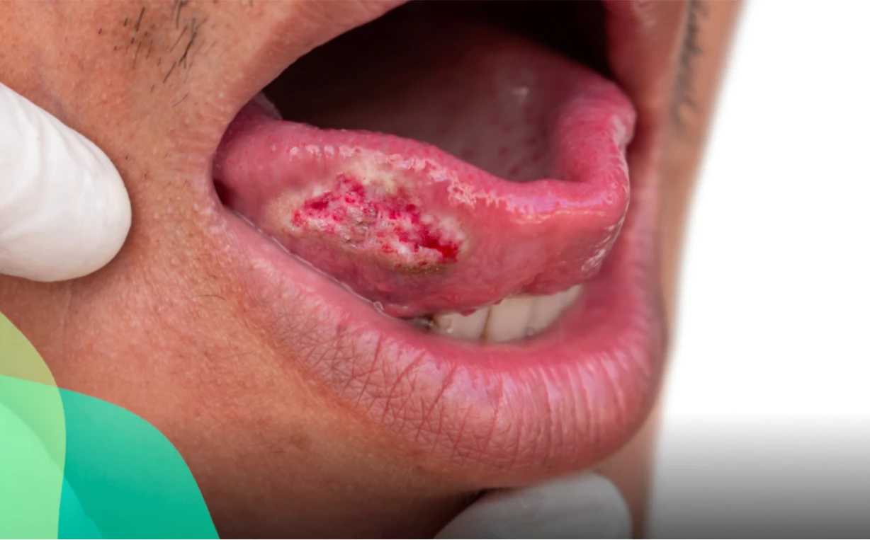 Oral Cancer