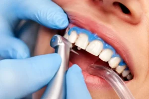 Comfortable Preparation & Gum Protection