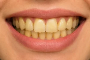 Yellow Teeth Whitening Before