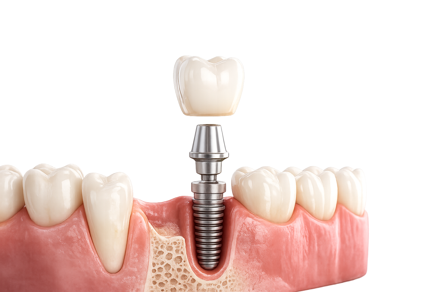 Choose Advanced Dental Implants?