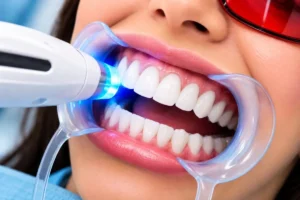 Yellow Teeth Whitening After