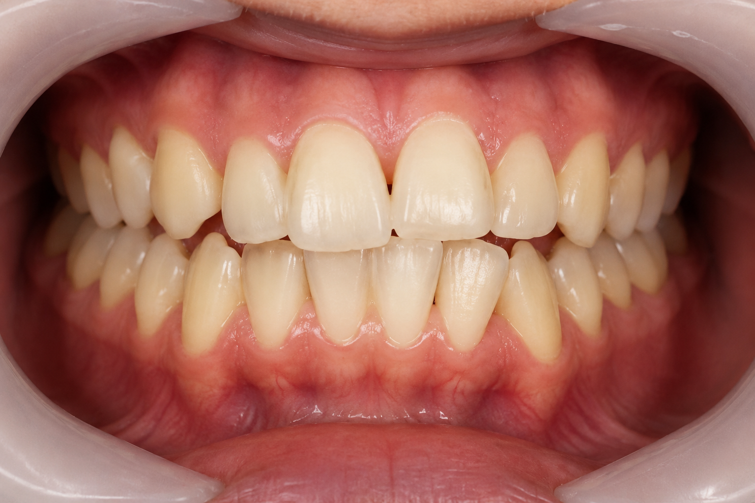 Clear Aligners Treatment Before
