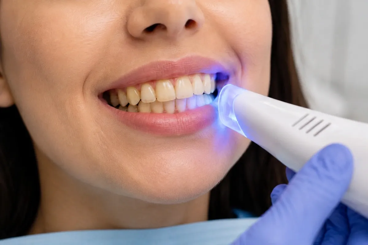Yellow Teeth Whitening Before
