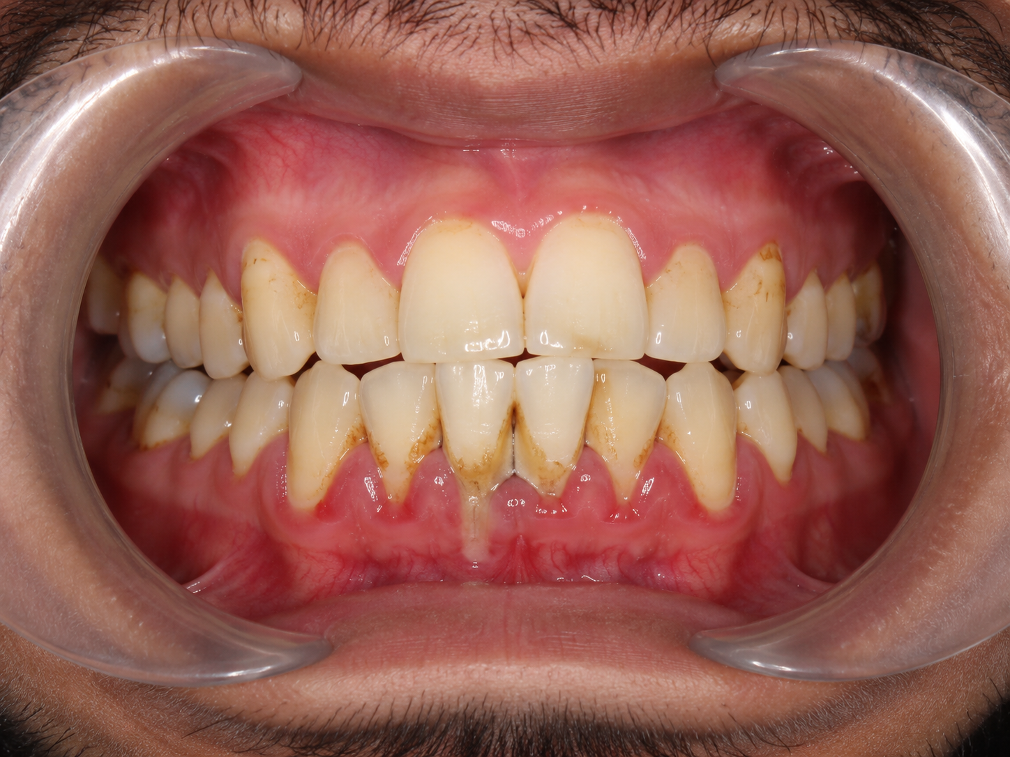 Dental Checkup Before