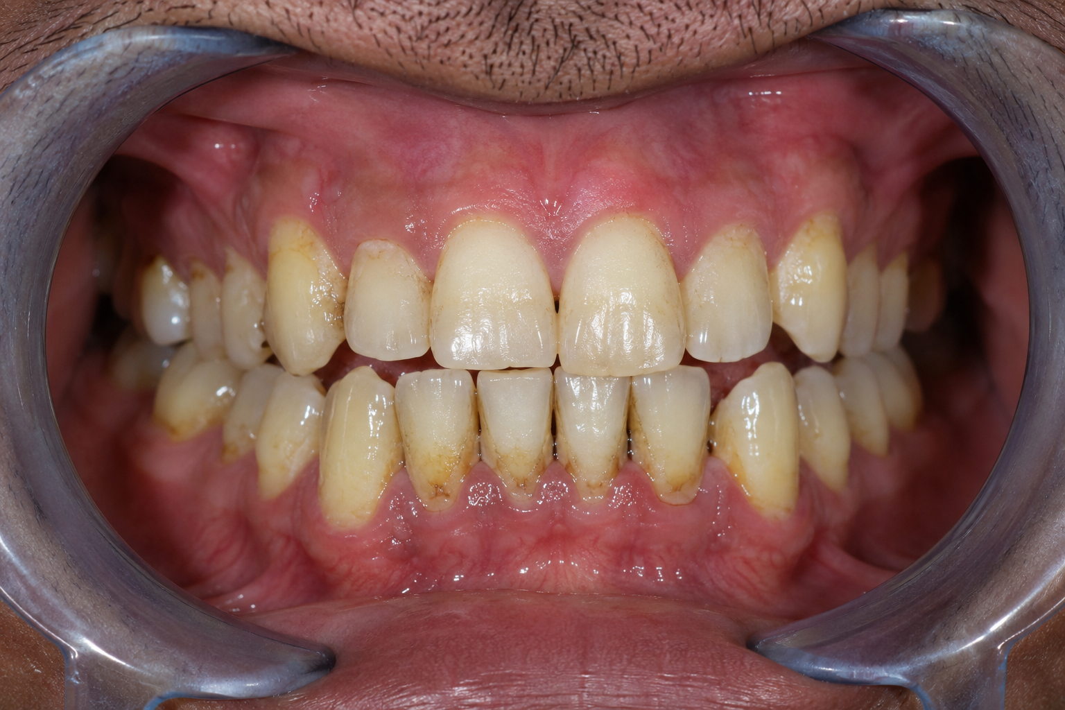 Dental Checkup Before